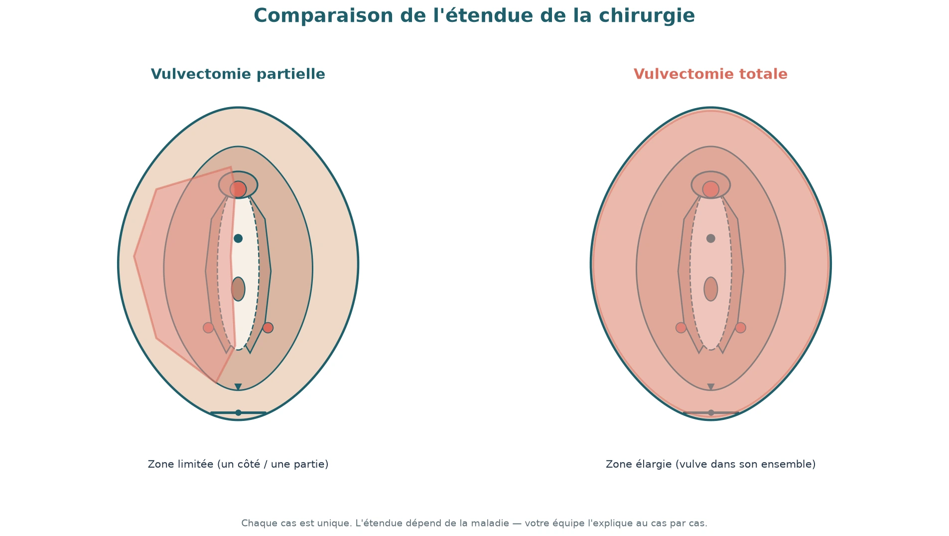 Vulvectomie partielle versus totale : schéma.