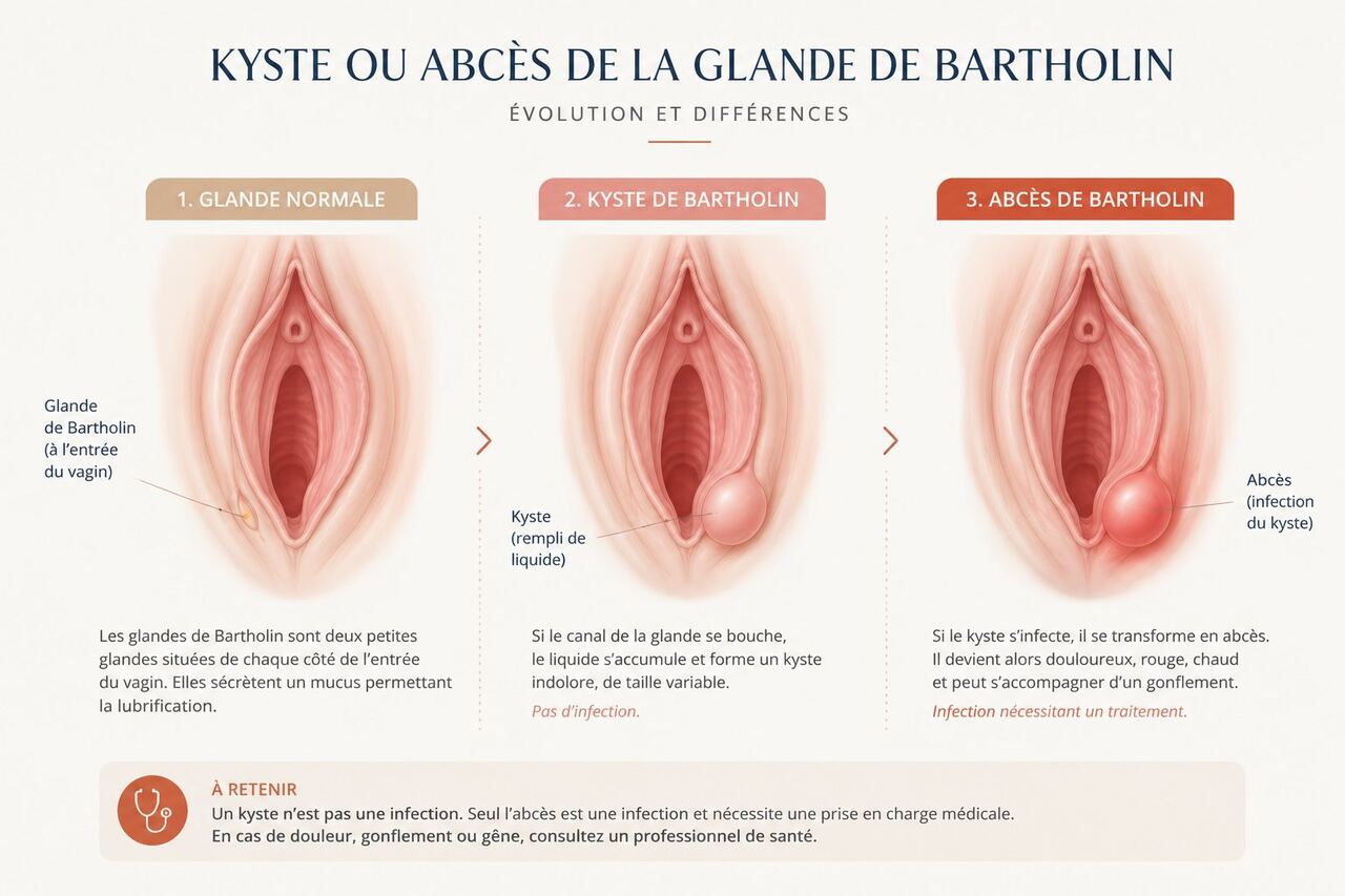 Kyste de Bartholin et bartholinite — comprendre votre chirurgie