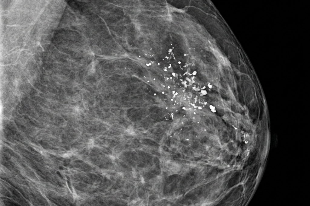 Foyer de microcalcifications groupées sur une mammographie, signe le plus fréquent d'un carcinome canalaire in situ