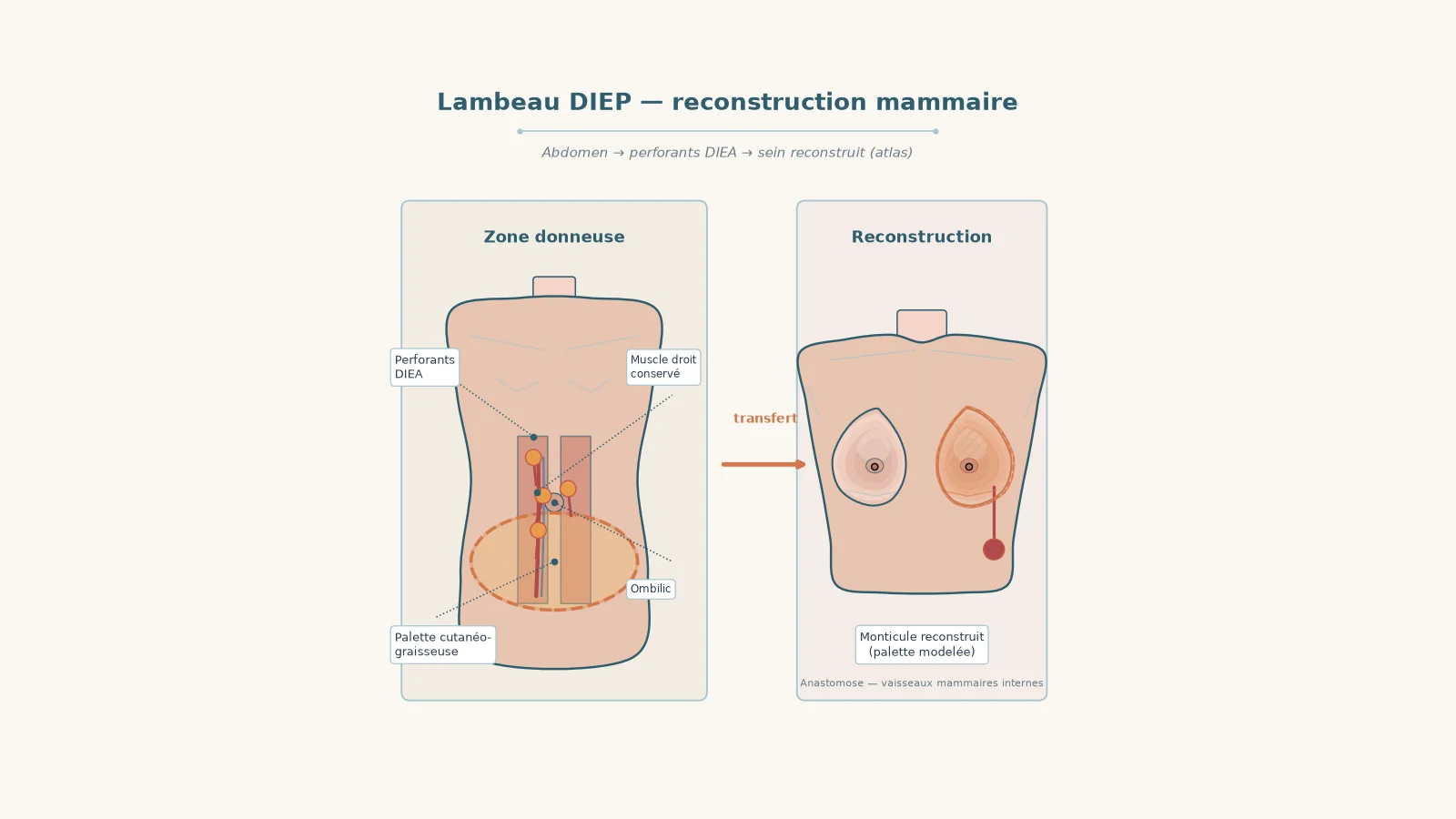 Schéma du lambeau DIEP : peau et graisse de l'abdomen transférées vers le sein