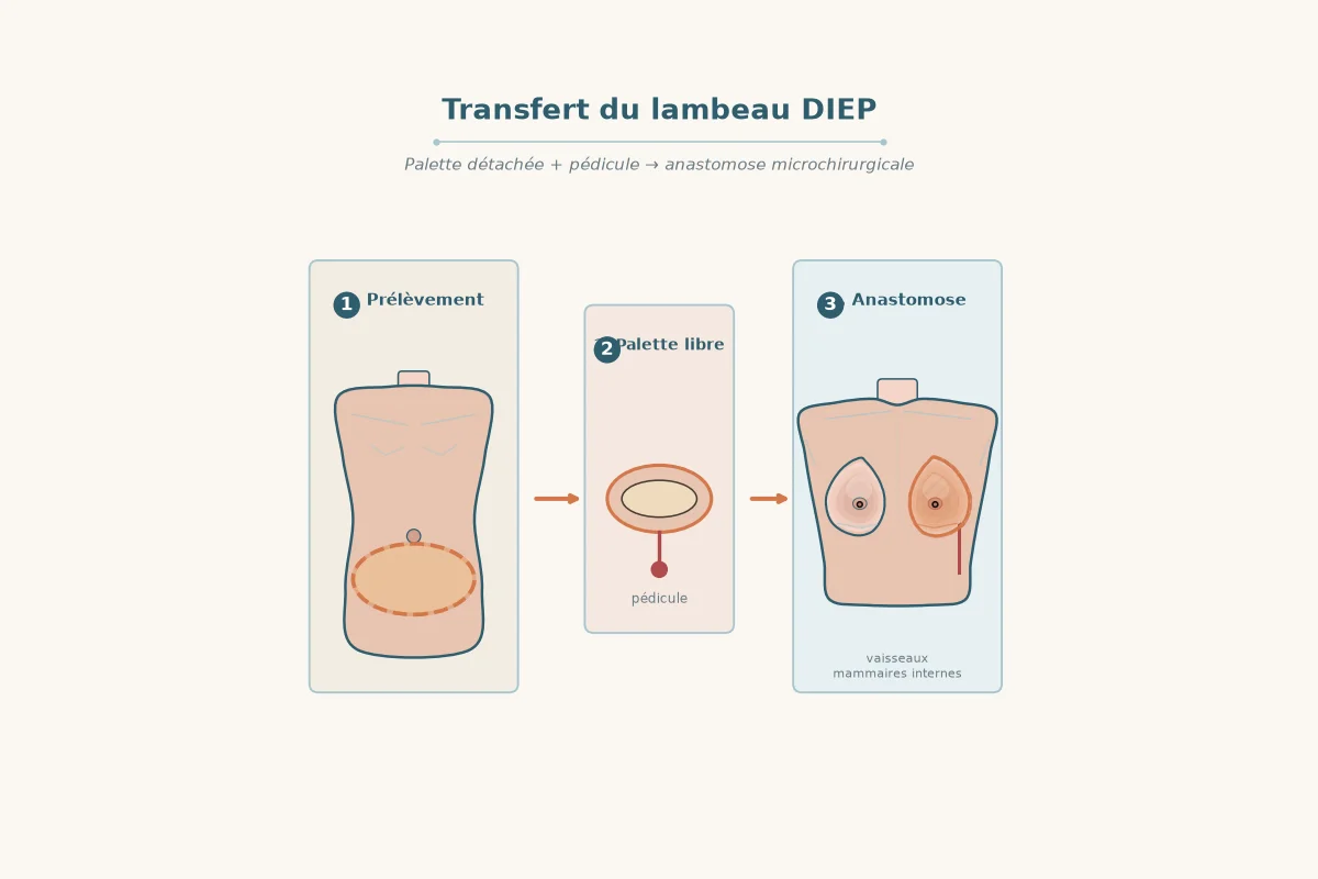 Schéma du transfert du lambeau DIEP de l'abdomen vers le thorax