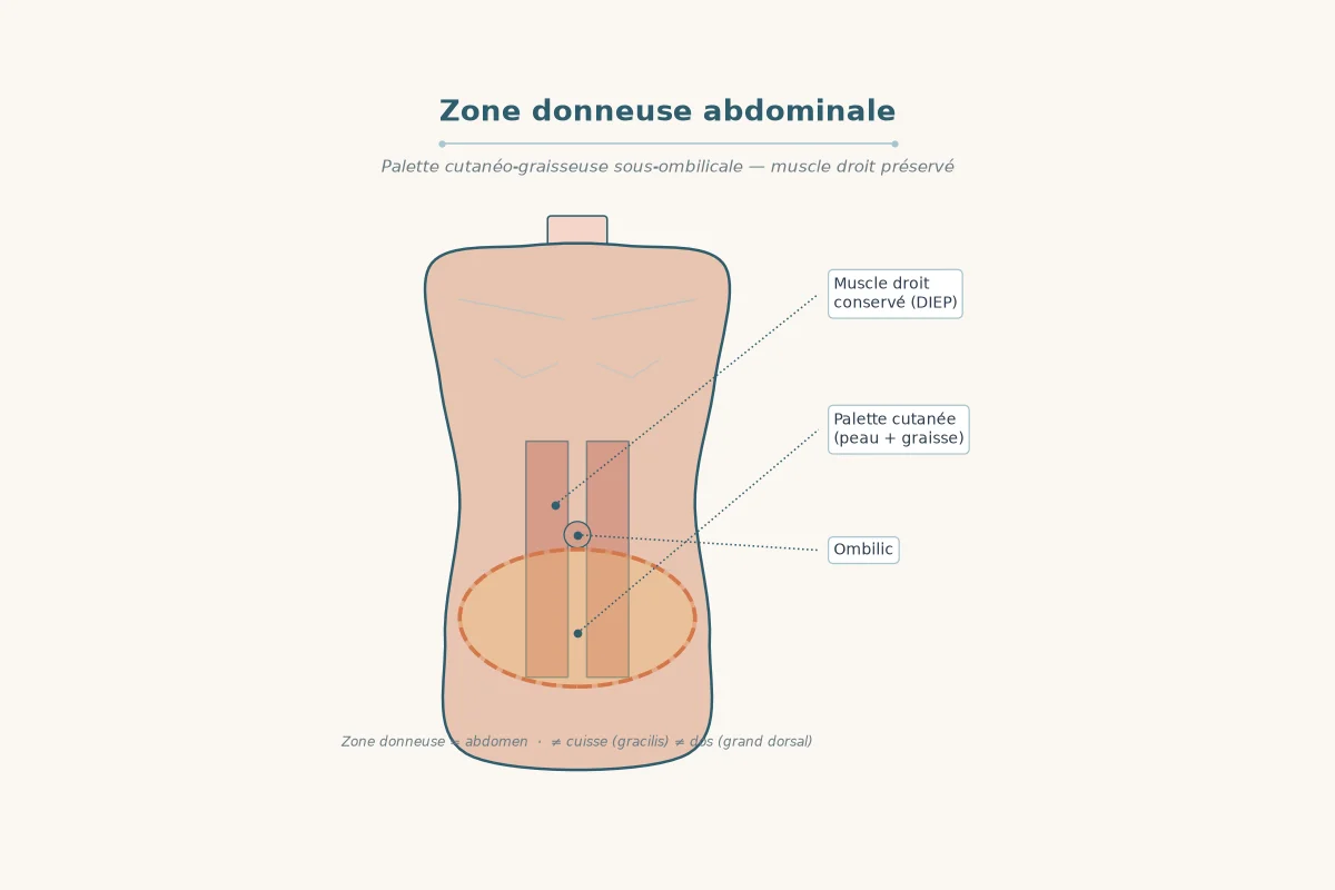Schéma de la zone donneuse abdominale du lambeau DIEP, sous le nombril