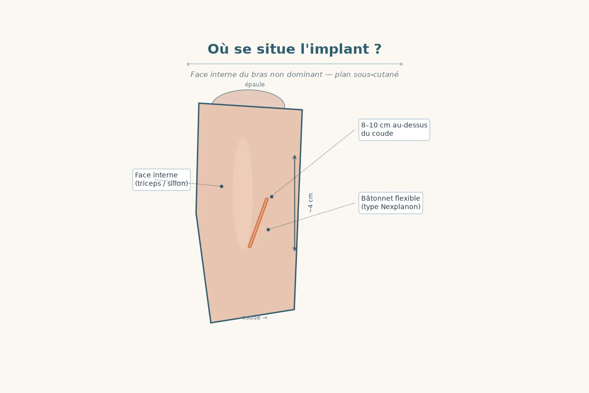 Coupe du bras montrant le bâtonnet contraceptif sous la peau ou plus profond