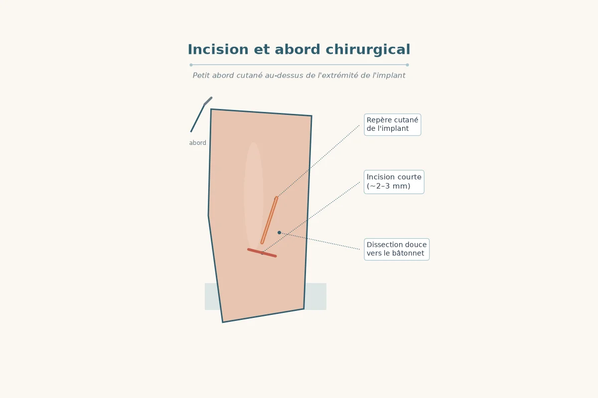 Schéma d'une courte incision à la face interne du bras pour atteindre le bâtonnet