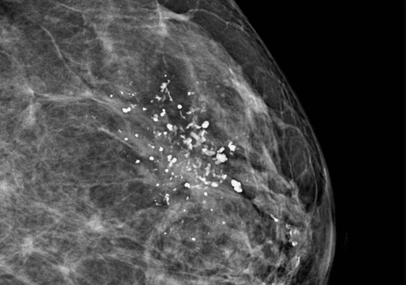 Mammogram: focus of microcalcifications — film alone