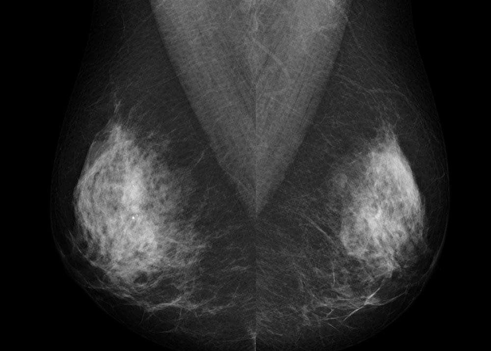 Cliché de mammographie bilatérale