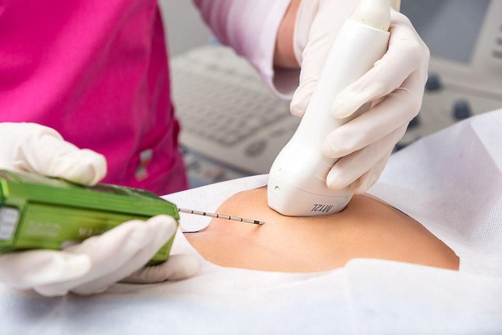 Microbiopsie mammaire échoguidée