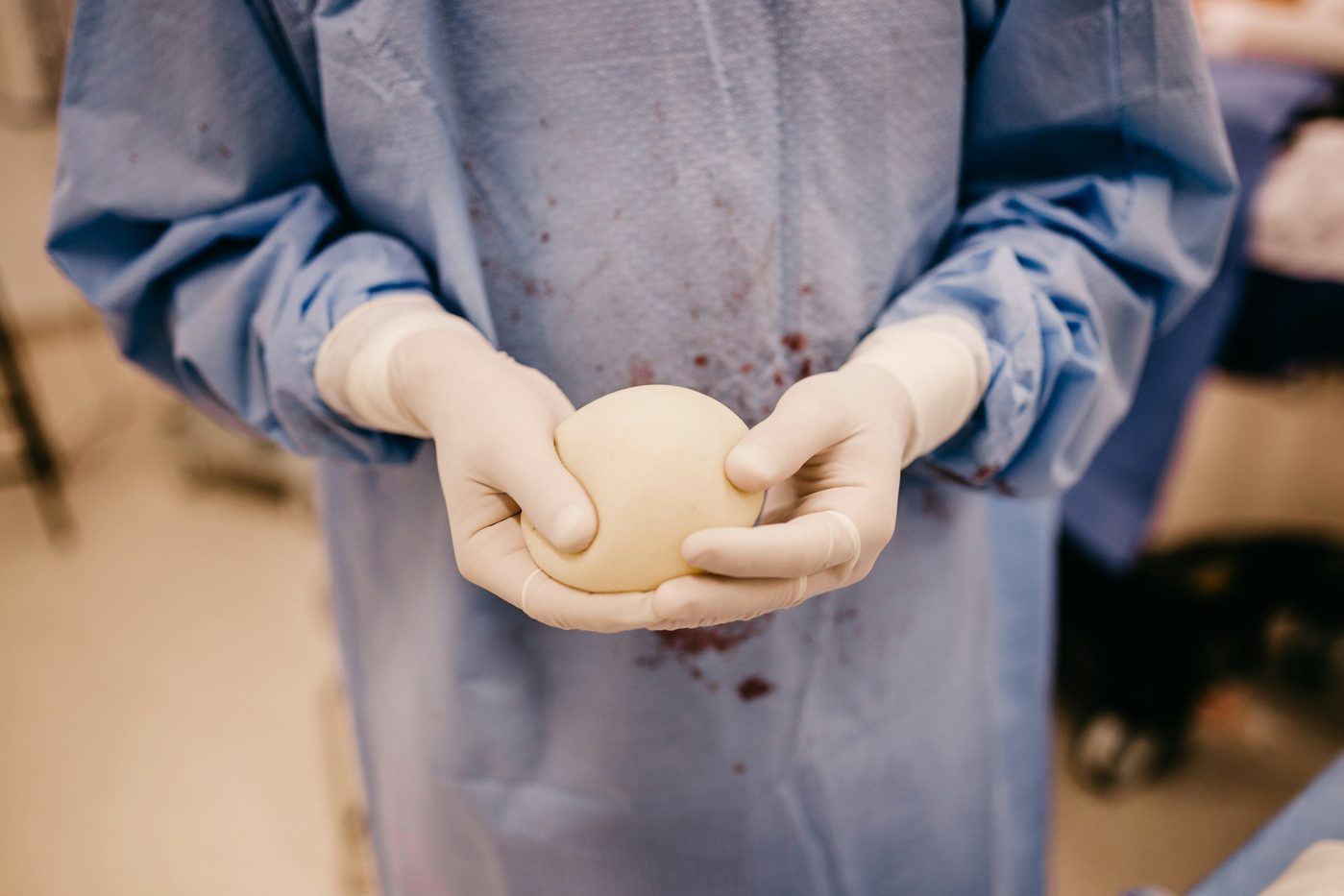 Surgeon holding a breast implant in operating room — selection and handling of the definitive implant during breast reconstruction, Dr Jérémie Zeitoun breast surgeon Paris 8th Clinique Hartmann Neuilly