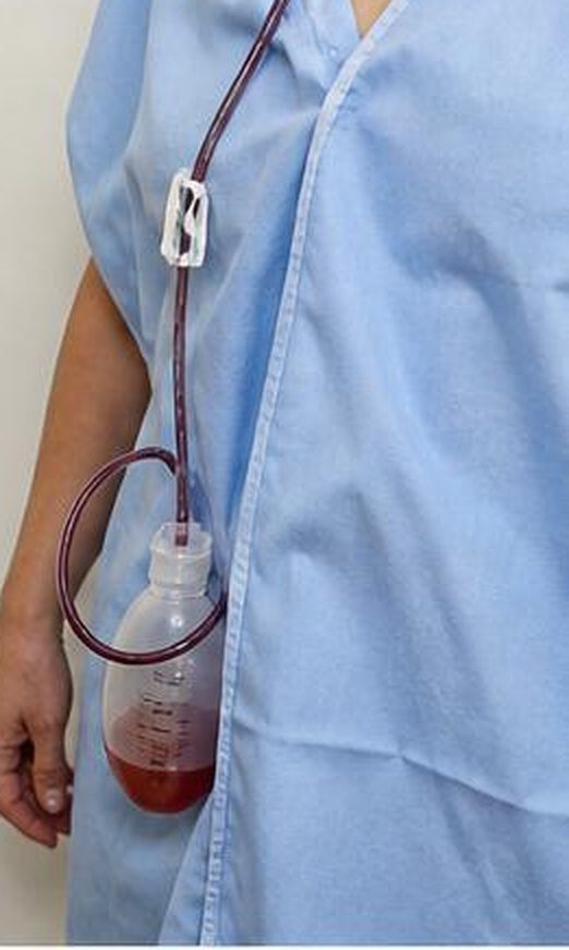 Suction Redon drain and collection bottle worn under the gown after surgery — painless and discreet post-operative drainage, follow-up Dr Jérémie Zeitoun breast surgical oncologist Paris 8 Clinique Hartmann