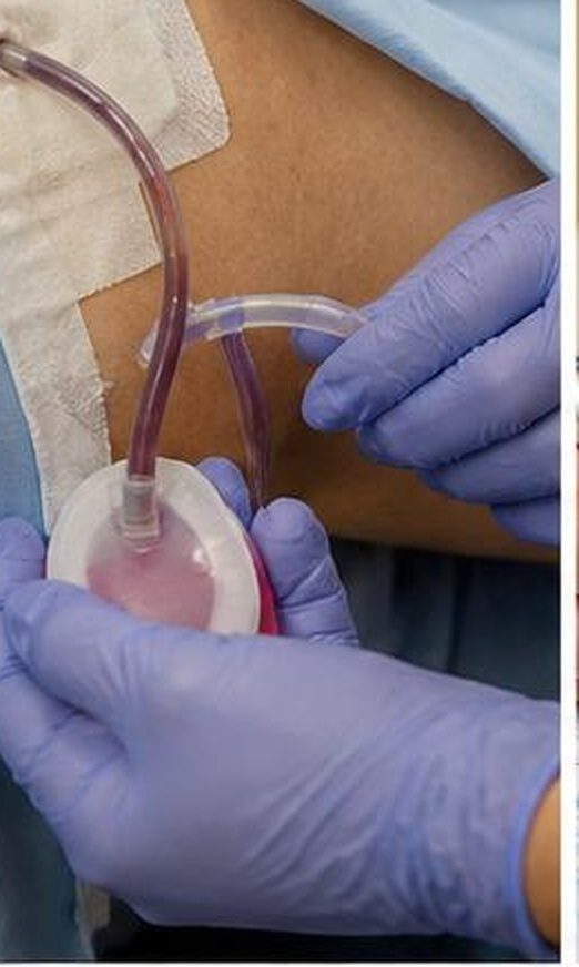 Aseptic Redon drain handling by a gloved caregiver — emptying and skin exit point care, follow-up Dr Jérémie Zeitoun breast surgical oncologist Paris